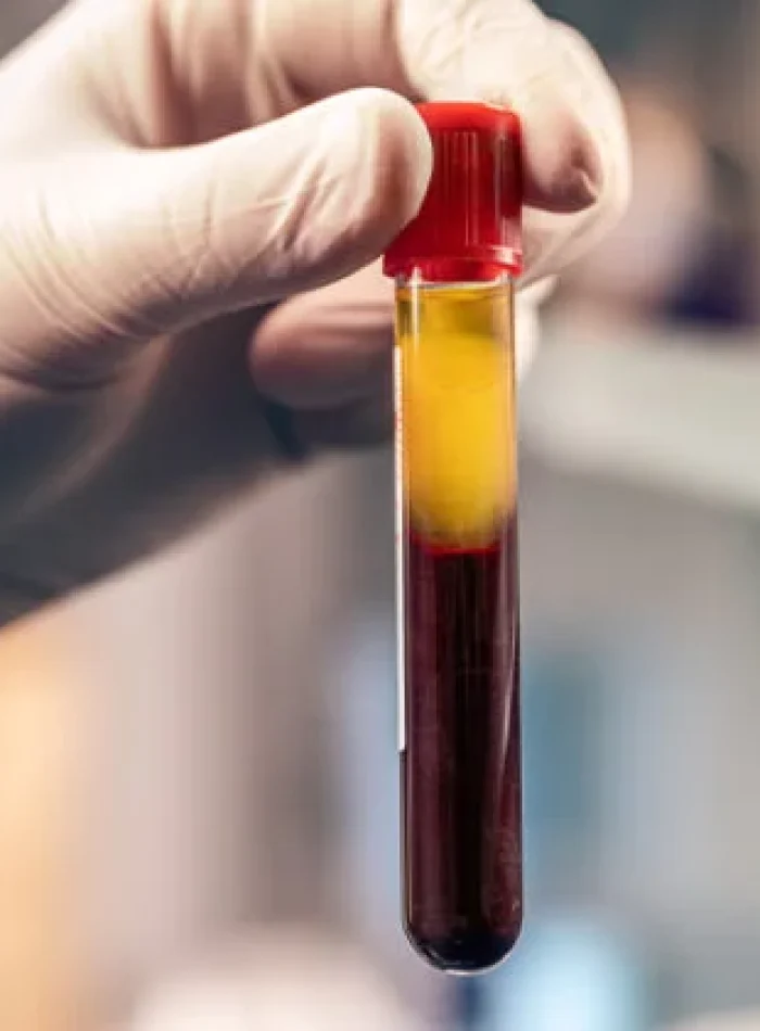 PRF_Treatment_Technology-708x421-1